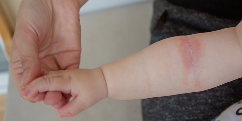 Какие опасные вирусные кожные инфекции часто встречаются в детских садах?