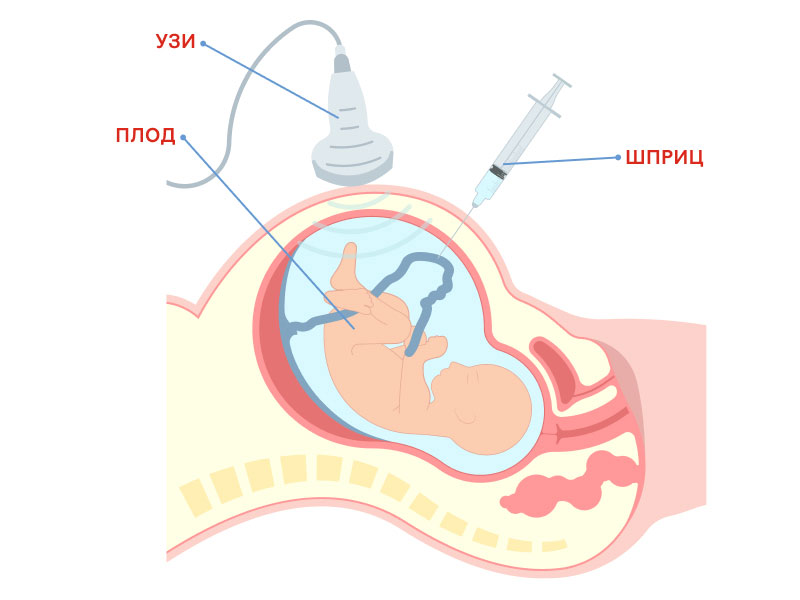 Как проводится биопсия ворсин хориона