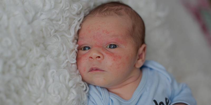 Стафилококковые гнойничковые заболевания кожи у детей
