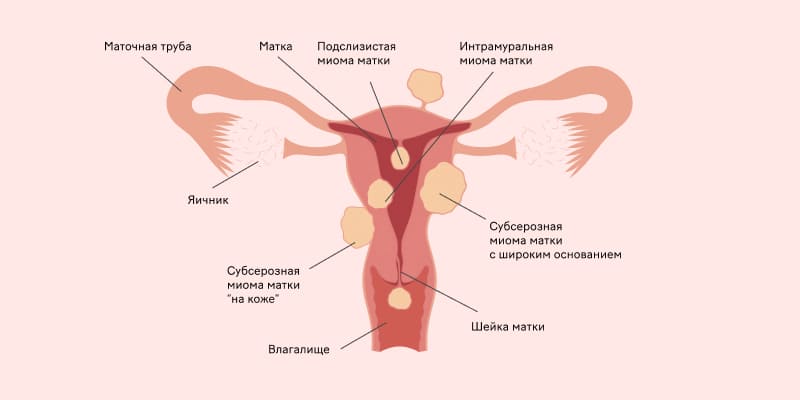 Расположение миоматозных узлов относительно частей матки