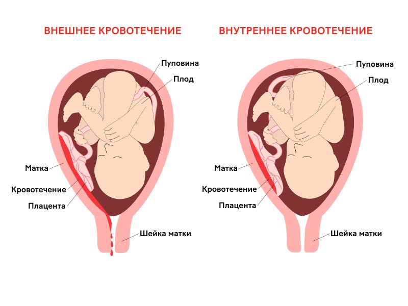 Кровотечение при отслойке плаценты