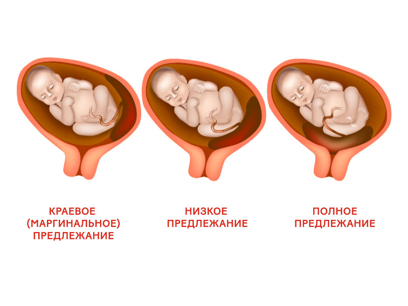 Как определить степень предлежания с помощью УЗИ?