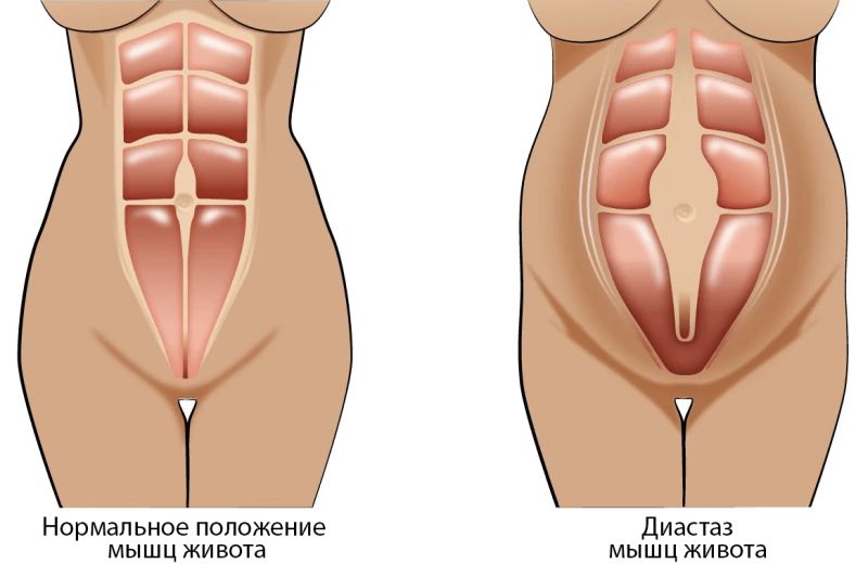 Диастаз мышц живота