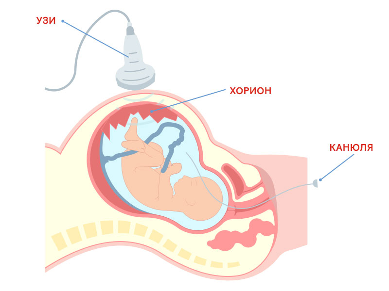 Трансцервикальная биопсия хориона