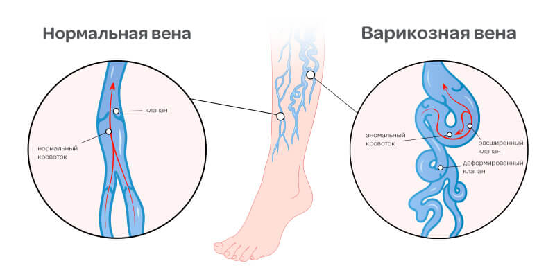 Симптомы варикоза во время беременности