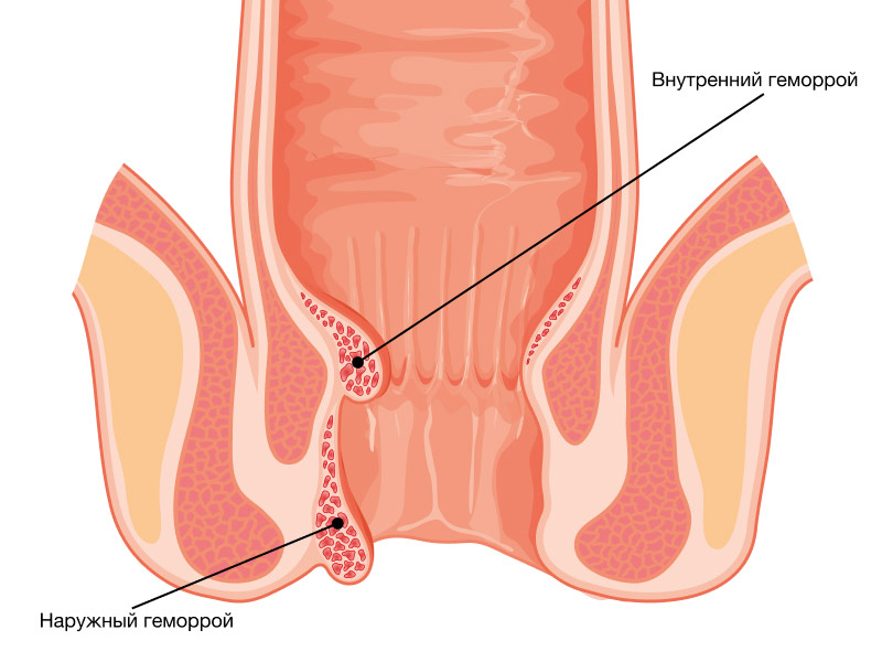 Геморрой при беременности