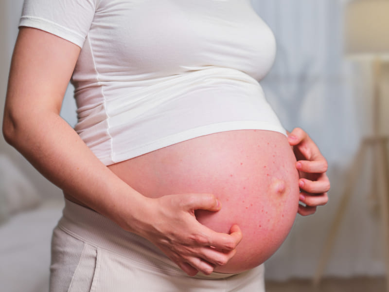 Какое влияние аллергия во время беременности может оказать на малыша?