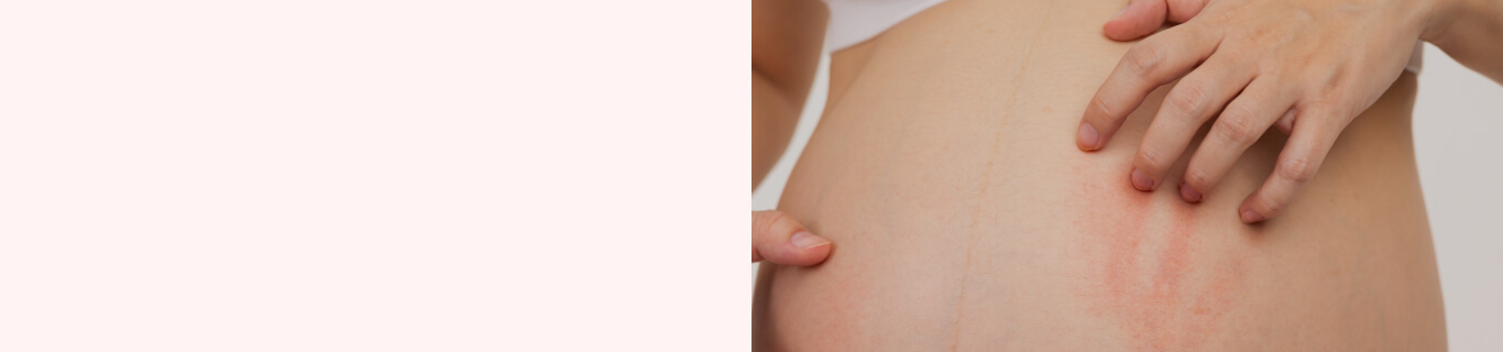 Кожный зуд во время беременности