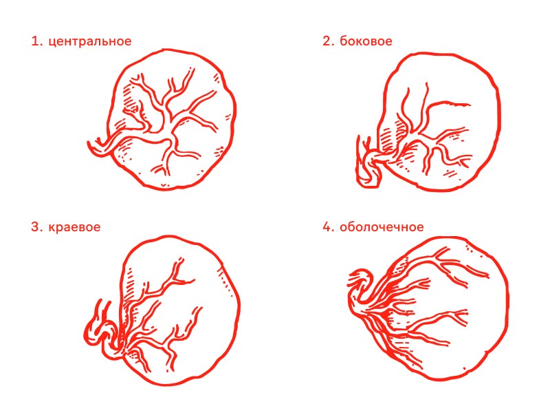 Варианты прикрепления пуповины